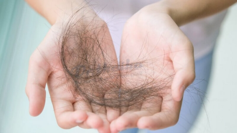Rụng tóc giai đoạn ngừng phát triển của tóc mãn tính