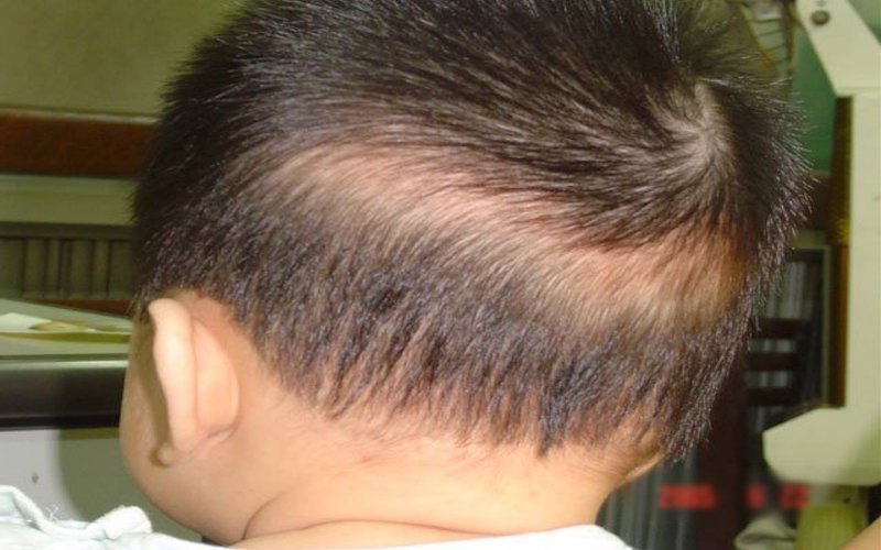 Nguyên nhân, dấu hiệu và cách điều trị rụng tóc vành khăn