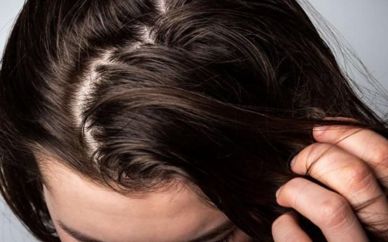 Dùng dầu gội khô thường xuyên có thể gây bít tắc lỗ chân lông tóc
